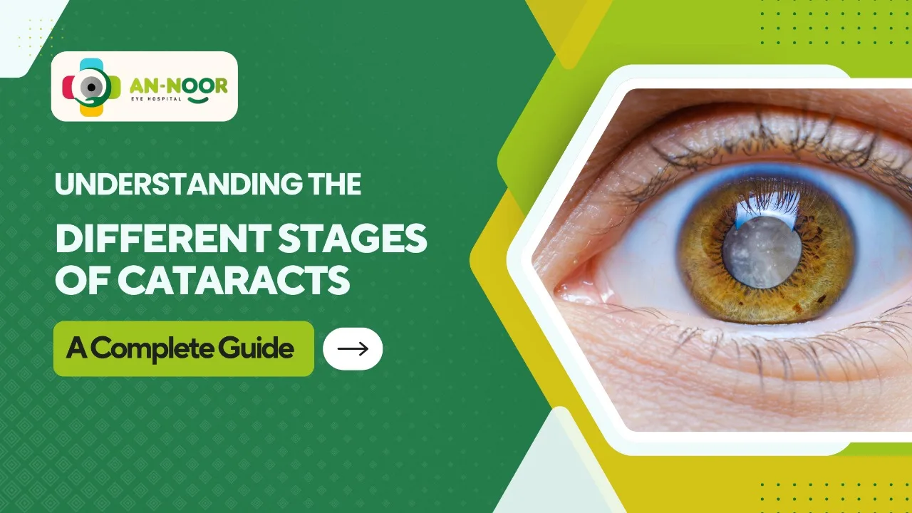 Understanding the Different Stages of Cataracts: A Complete Guide