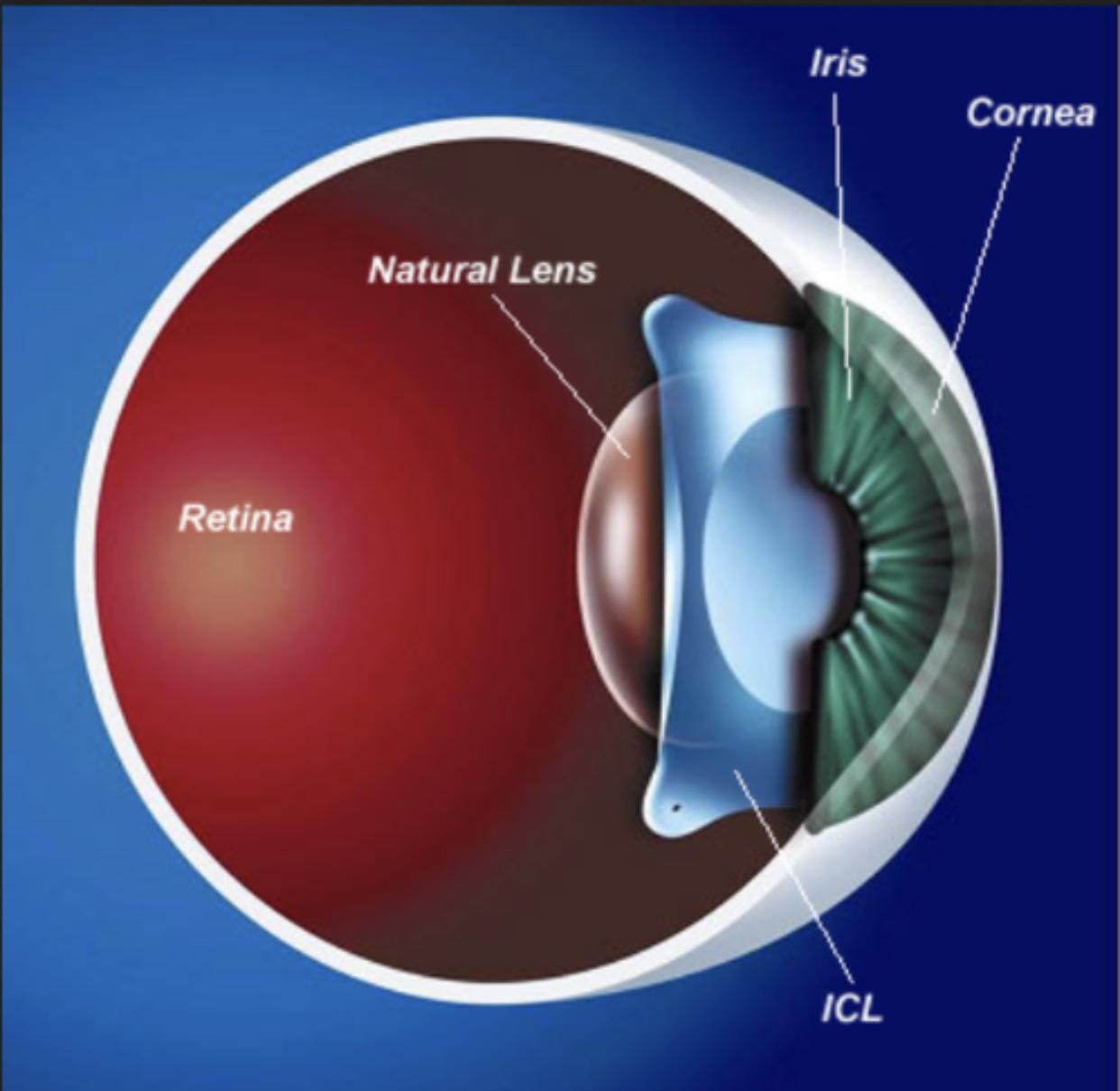 Refractive Correction Refractive Correction in Periyamet, Chennai | An-Noor Eye Hospital